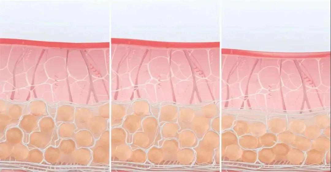 天天戴口罩可以防止法令纹吗,戴口罩容易长法令纹吗