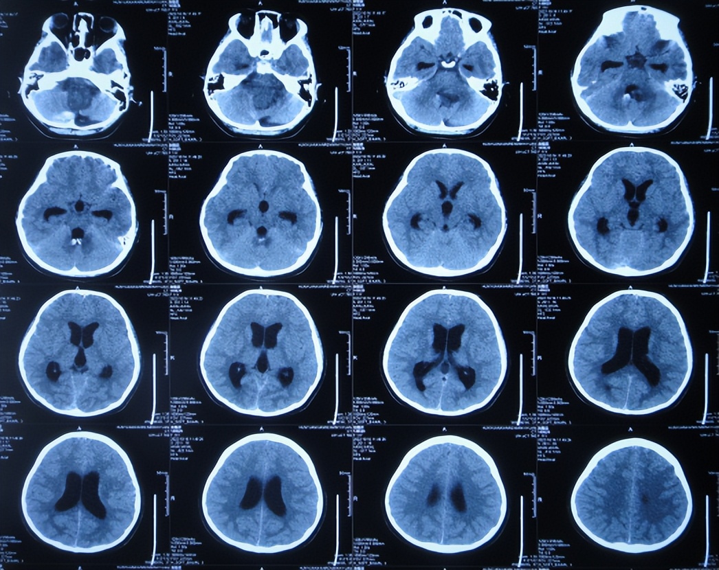 脑干出血儿童,儿童脑干胶质瘤呕吐