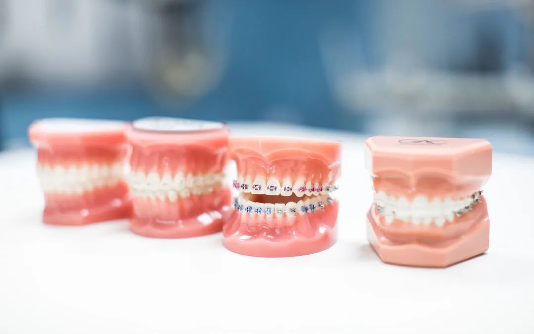 暑期牙齿矫正黄金季,牙齿矫正省钱攻略