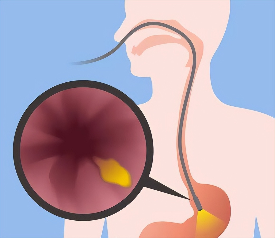 无痛胃镜与普通胃镜的区别是什么,普通胃镜与无痛胃镜的区别