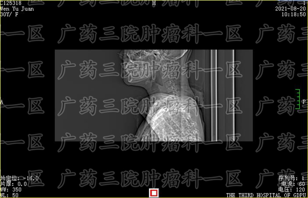 广州肿瘤在哪里就医好,广州哪里有治疗宫颈癌的好中医