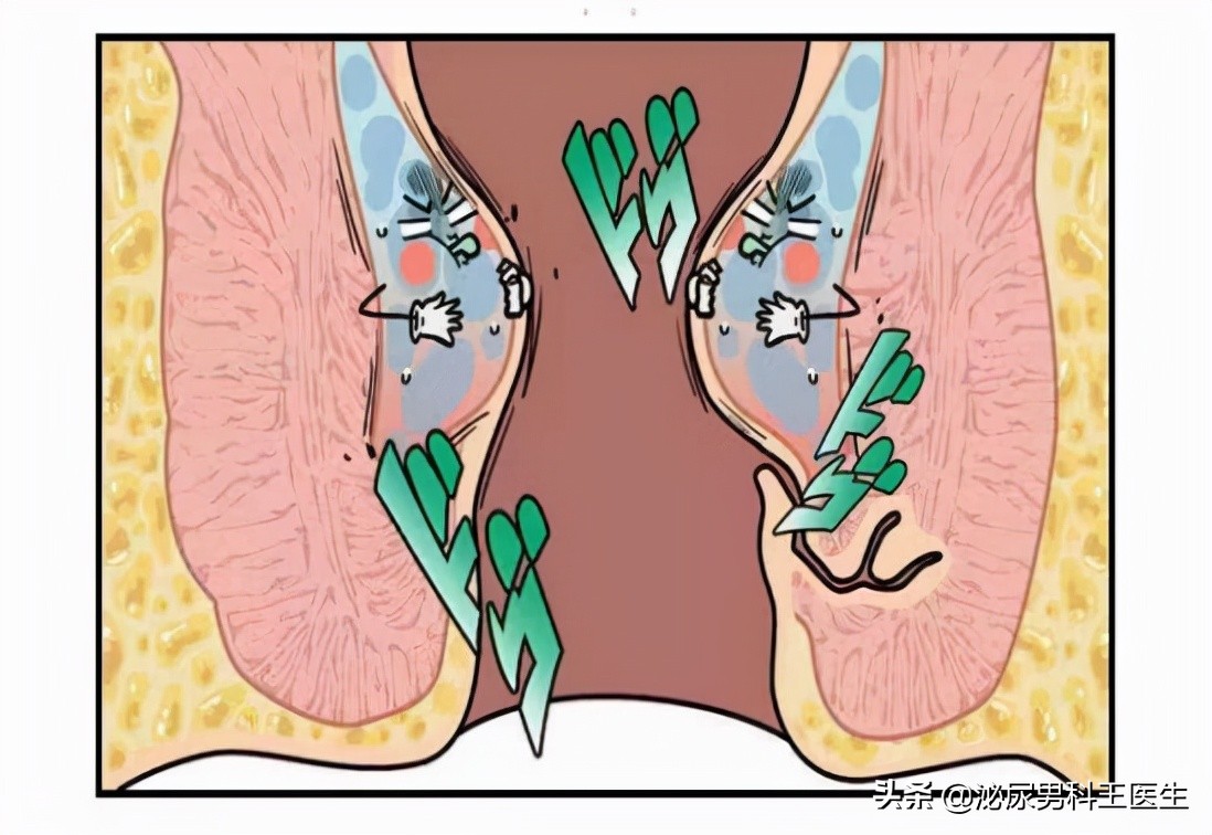 肛门潮湿发痒是什么病,肛门潮湿瘙痒是什么病怎样治愈