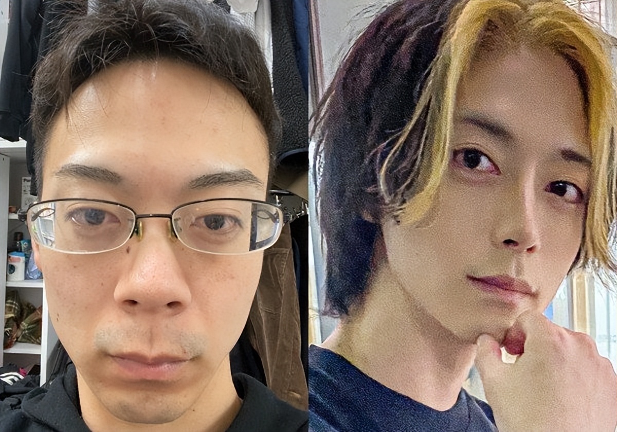 日本1米5小哥砸1600万疯狂整容增高！断骨惨烈过程吓傻网友