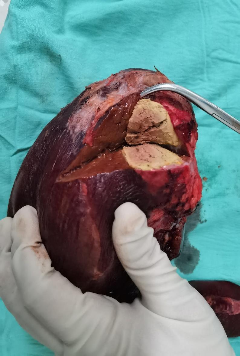 哈医大肝脏手术,哈医大肝移植