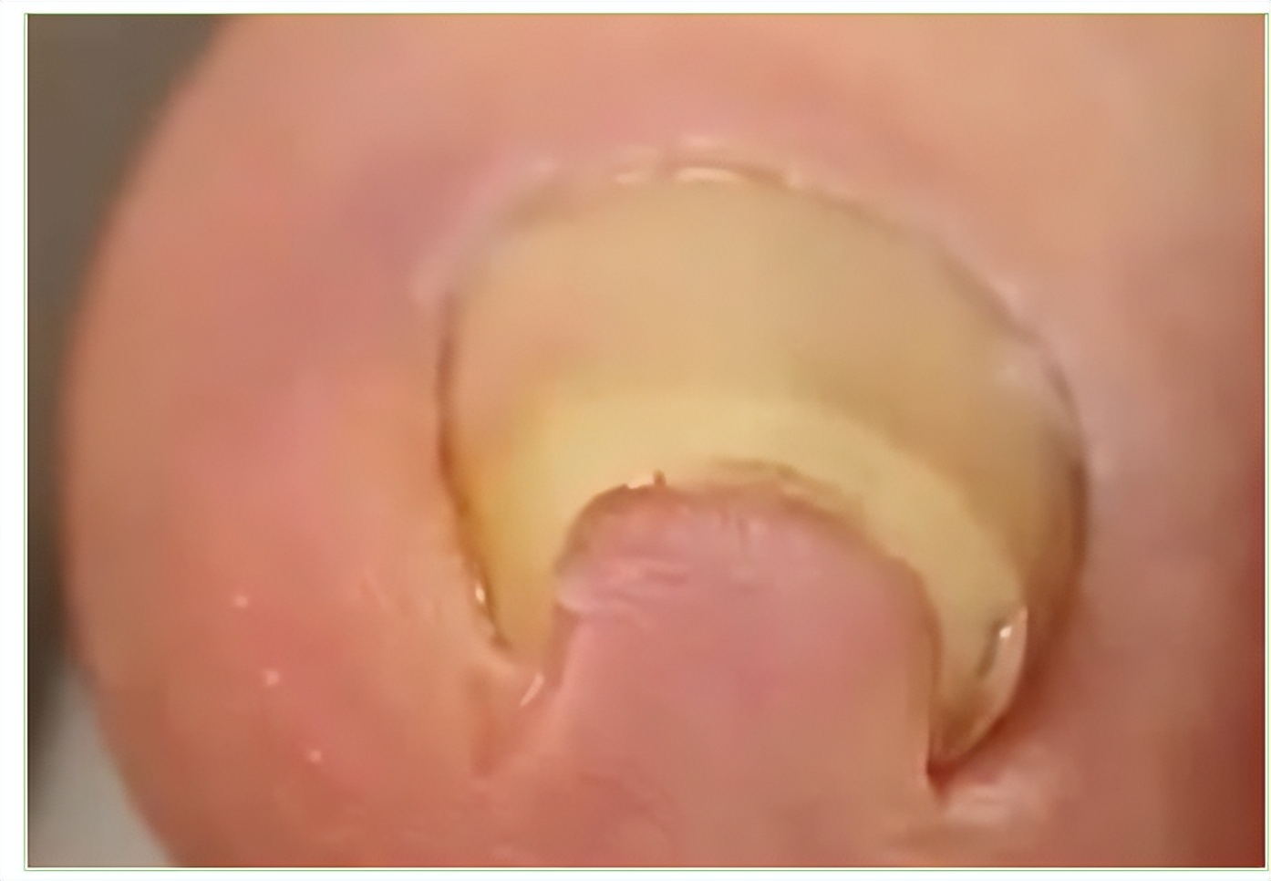 嵌甲危害大，防止有方法