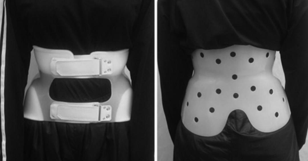 轻度峡部裂和重度峡部裂的区别,真性峡部裂和假性峡部裂