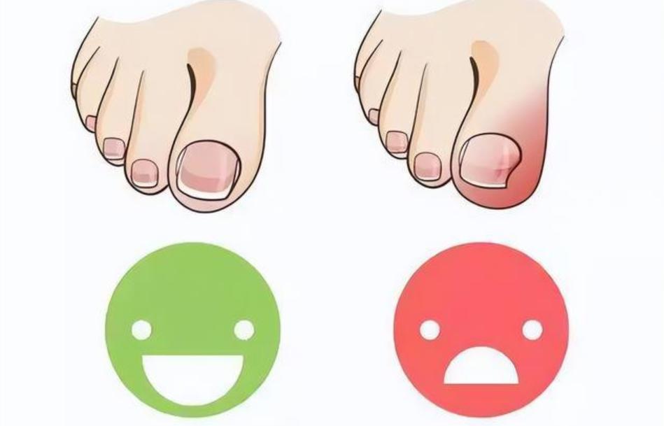 脚趾甲老是往肉里面钻是咋回事,脚趾甲老往肉里钻