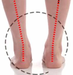 如何判断足弓过低,足弓塌陷对腿型影响