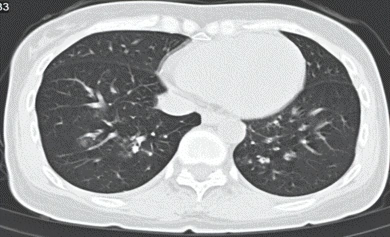 肺部长蘑菇是什么病,肺部有蘑菇结节