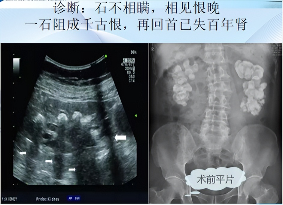 明知山有虎,偏向虎山行——肾斗士VS肾结石