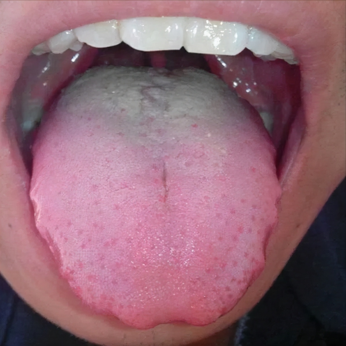 舌诊辨证和精准用药,中医诊病无需诊脉和观舌象靠谱不