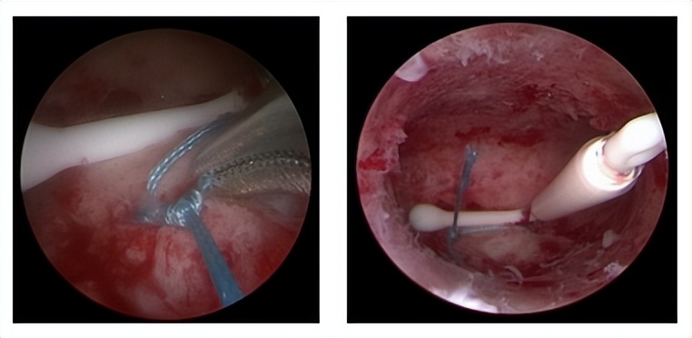 子宫腺肌症安环治疗,子宫腺肌症戴环有用吗