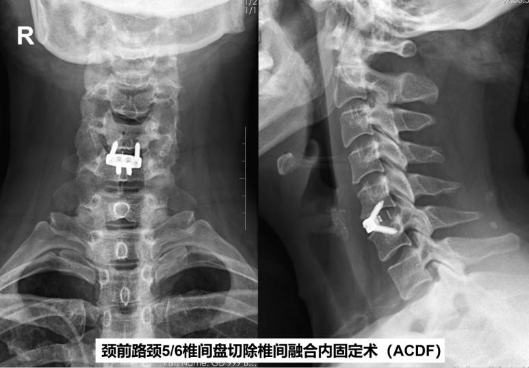 手痛手麻手僵硬是什么原因,手麻引起手指中节疼是什么原因