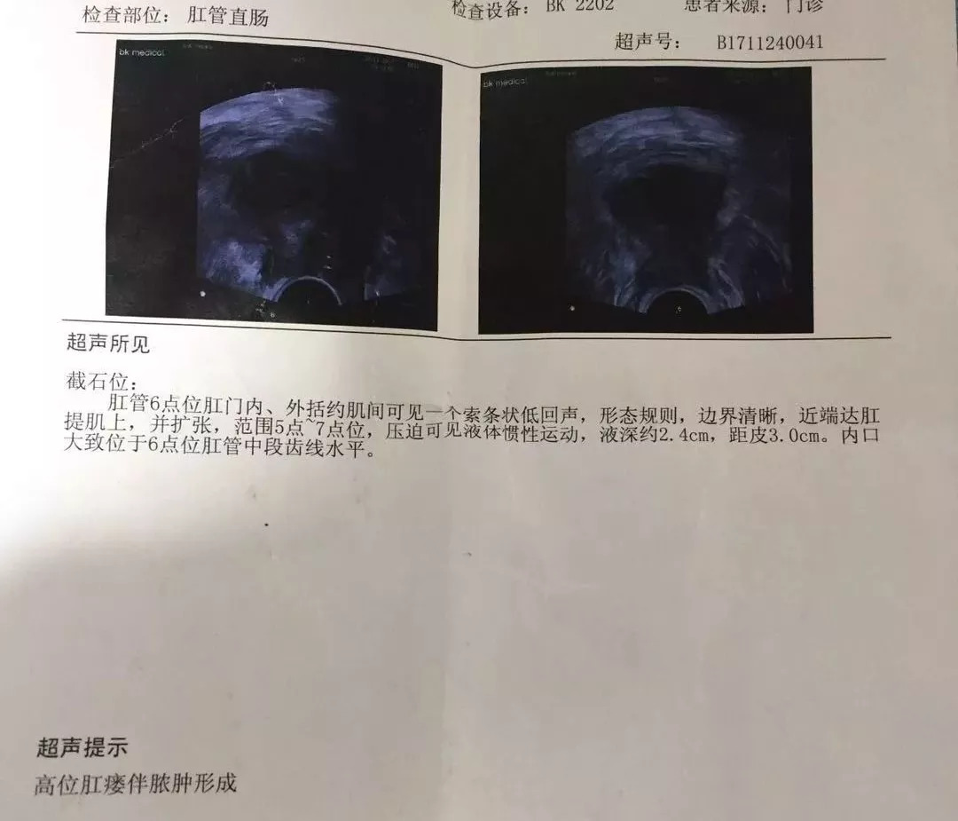 动力学原理指导下的高位复杂性肛瘘手术