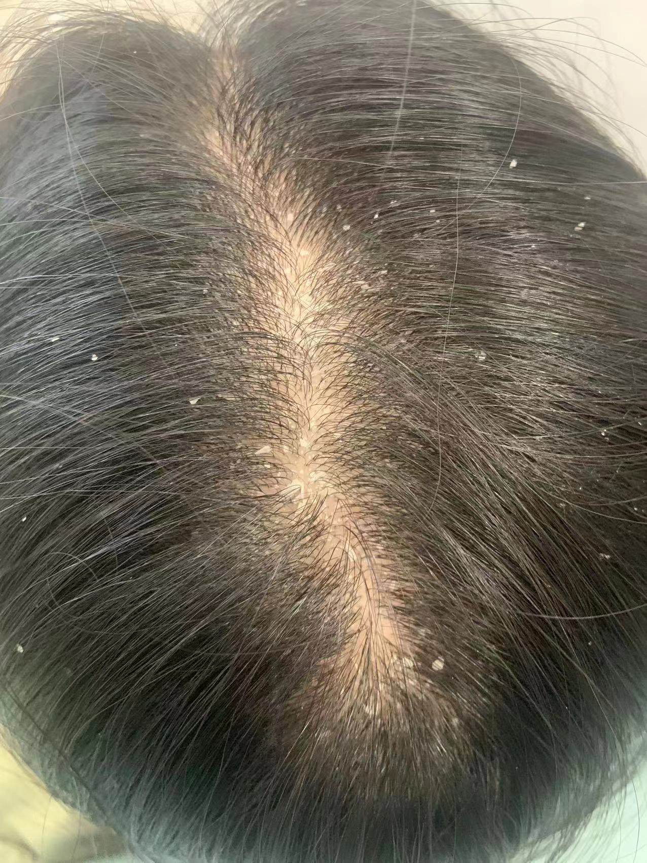 去屑控油洗发水什么牌子最好,去屑控油洗发水什么牌子好