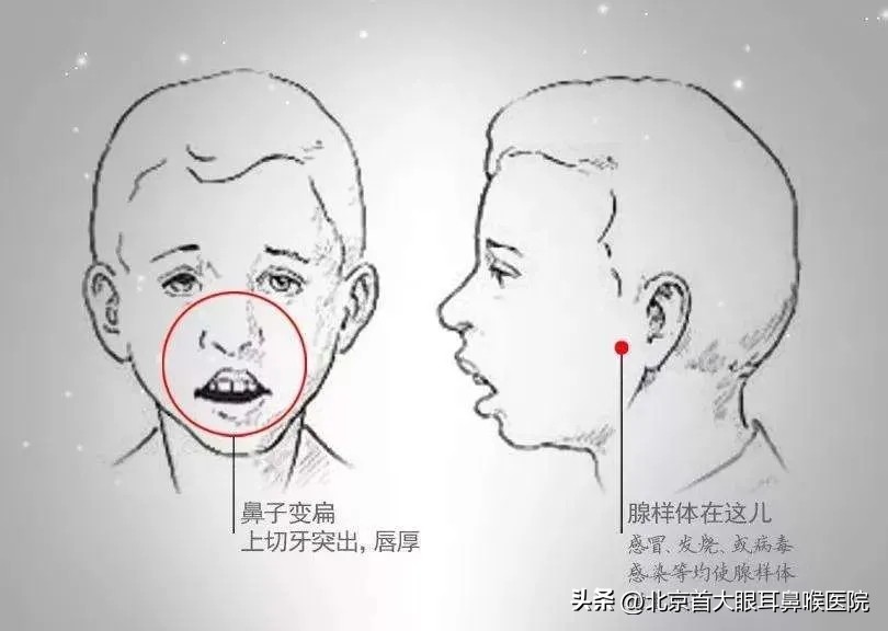 闭嘴呼吸能改善腺样体面容吗,已经成年了腺样体面容怎么改善