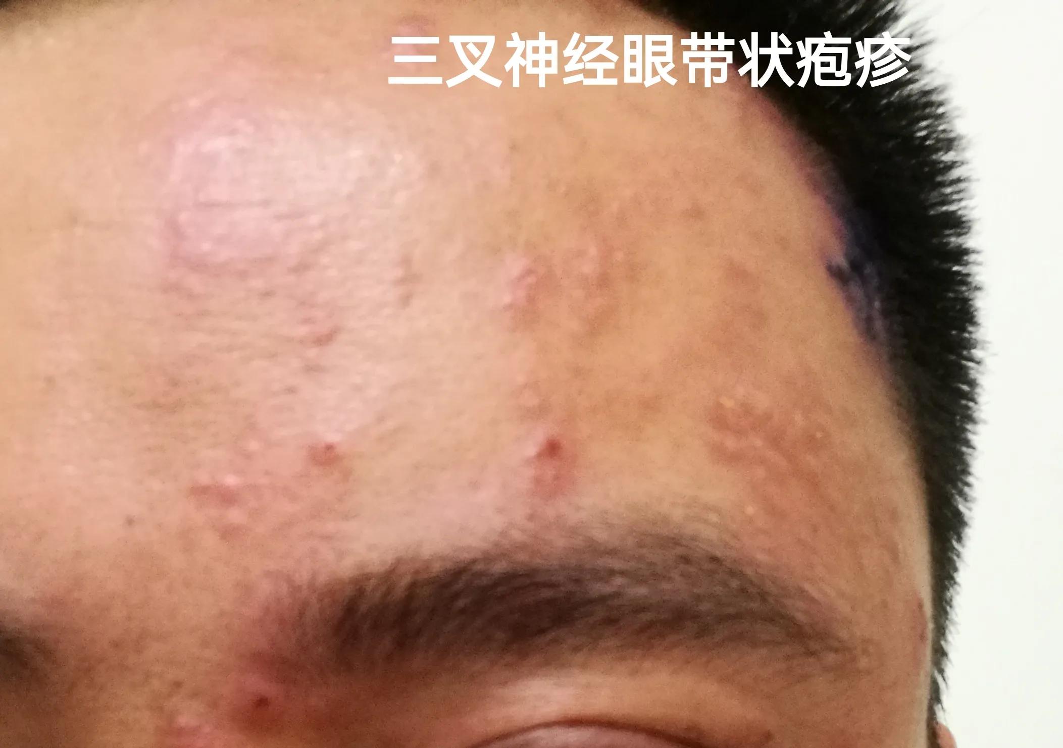 头上带状疱疹好后的后遗症有哪些,头上长带状疱疹会留后遗症吗