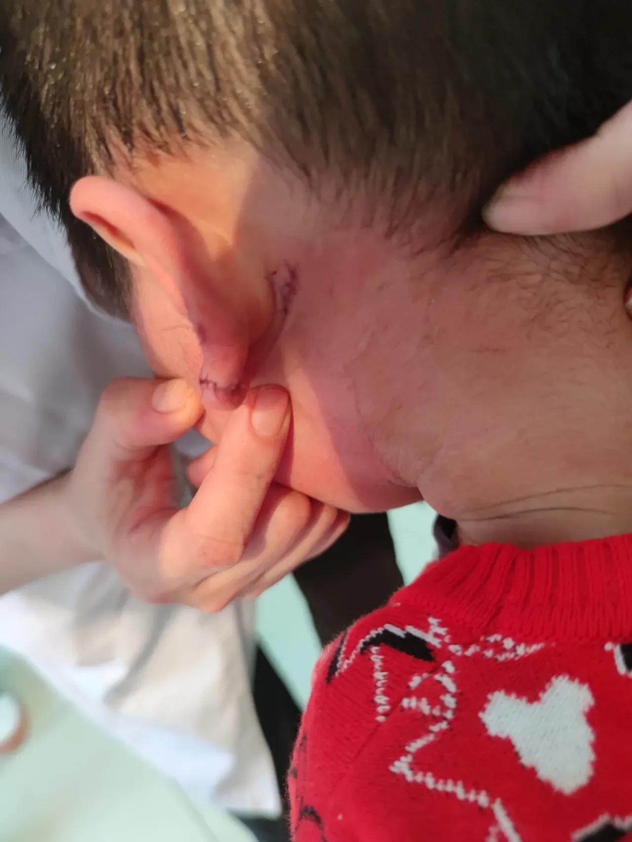 宝宝在幼儿园受伤缝针合理赔偿,幼儿园摔伤缝针赔偿标准