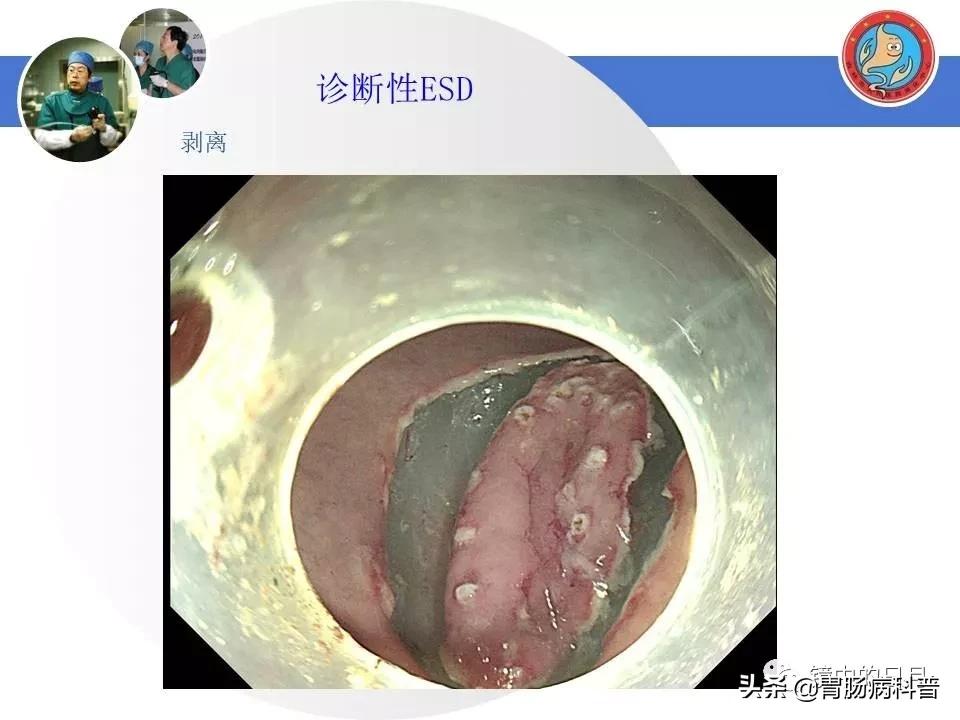 胃癌可以做内镜手术吗,早期胃癌内镜手术后追加外科手术
