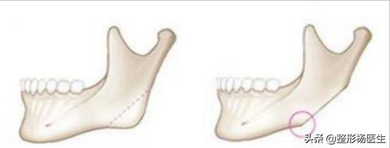 削骨后遗症最严重的后果,削骨失败案例后遗症