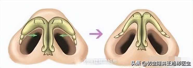 隆鼻鼻头大是失败了吗,大鼻头隆鼻手术案例