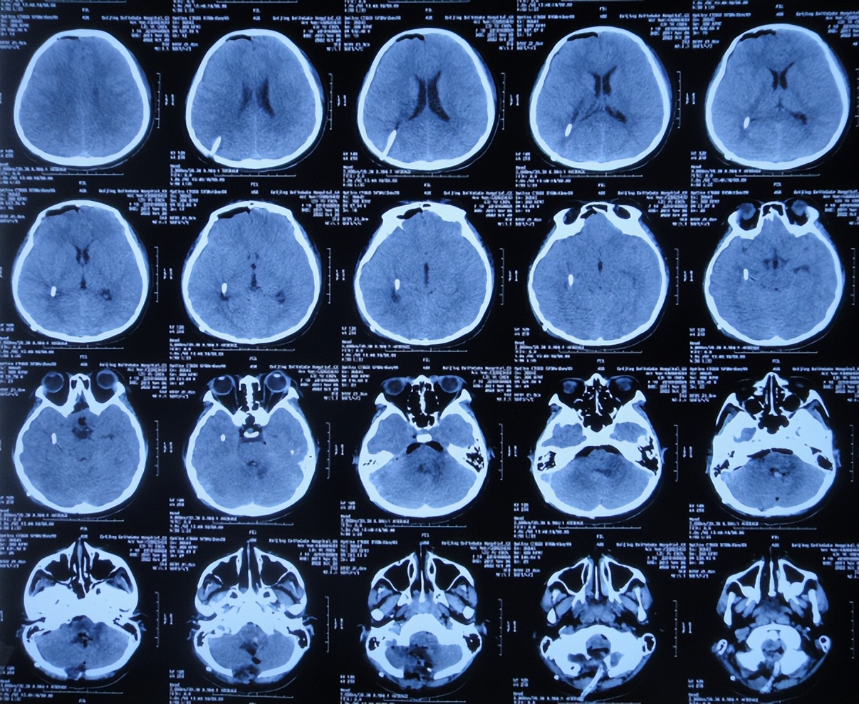 脑干出血儿童,儿童脑干胶质瘤呕吐