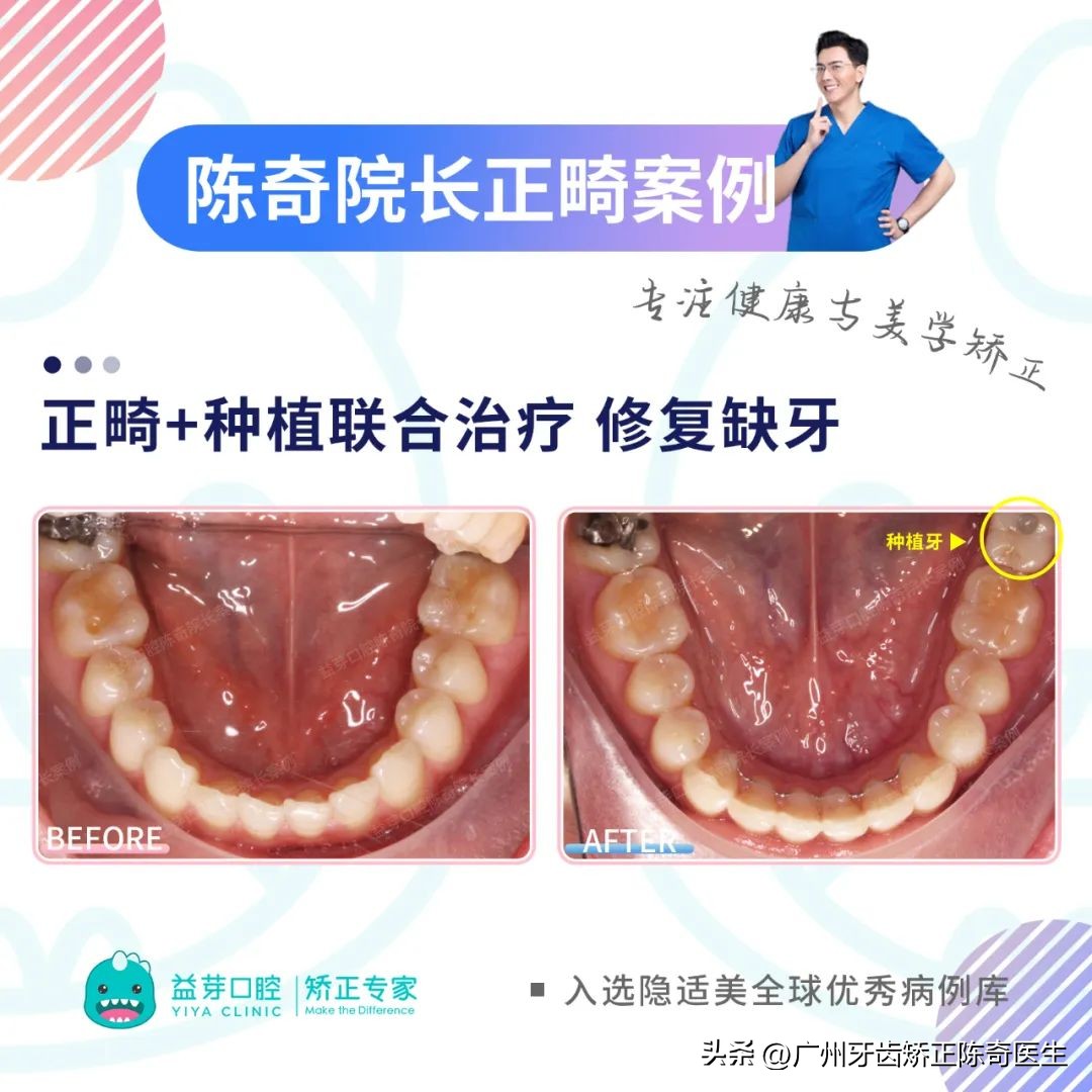 正畸治疗的基本矫治方法,正畸修复联合案例