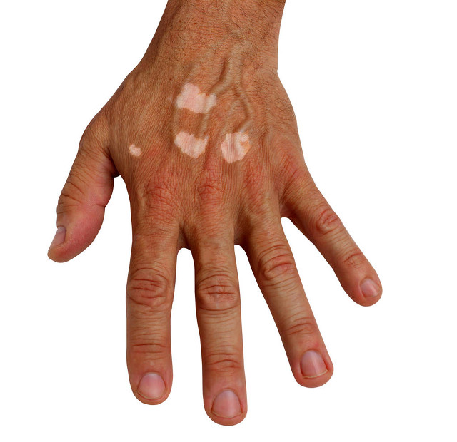 患者需要知道的白癜风护理常识,白癜风患者如何消除恐惧