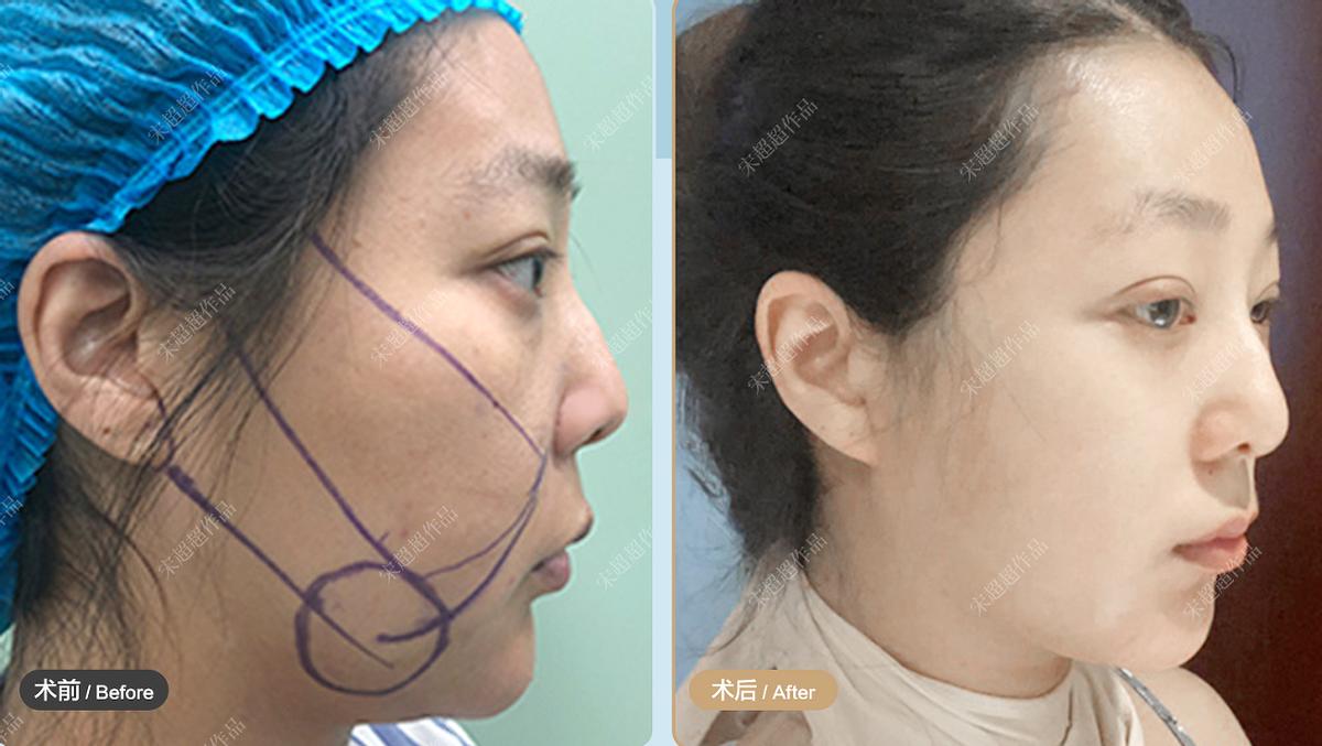 面部平整度是什么意思,怎样提高面部平整度