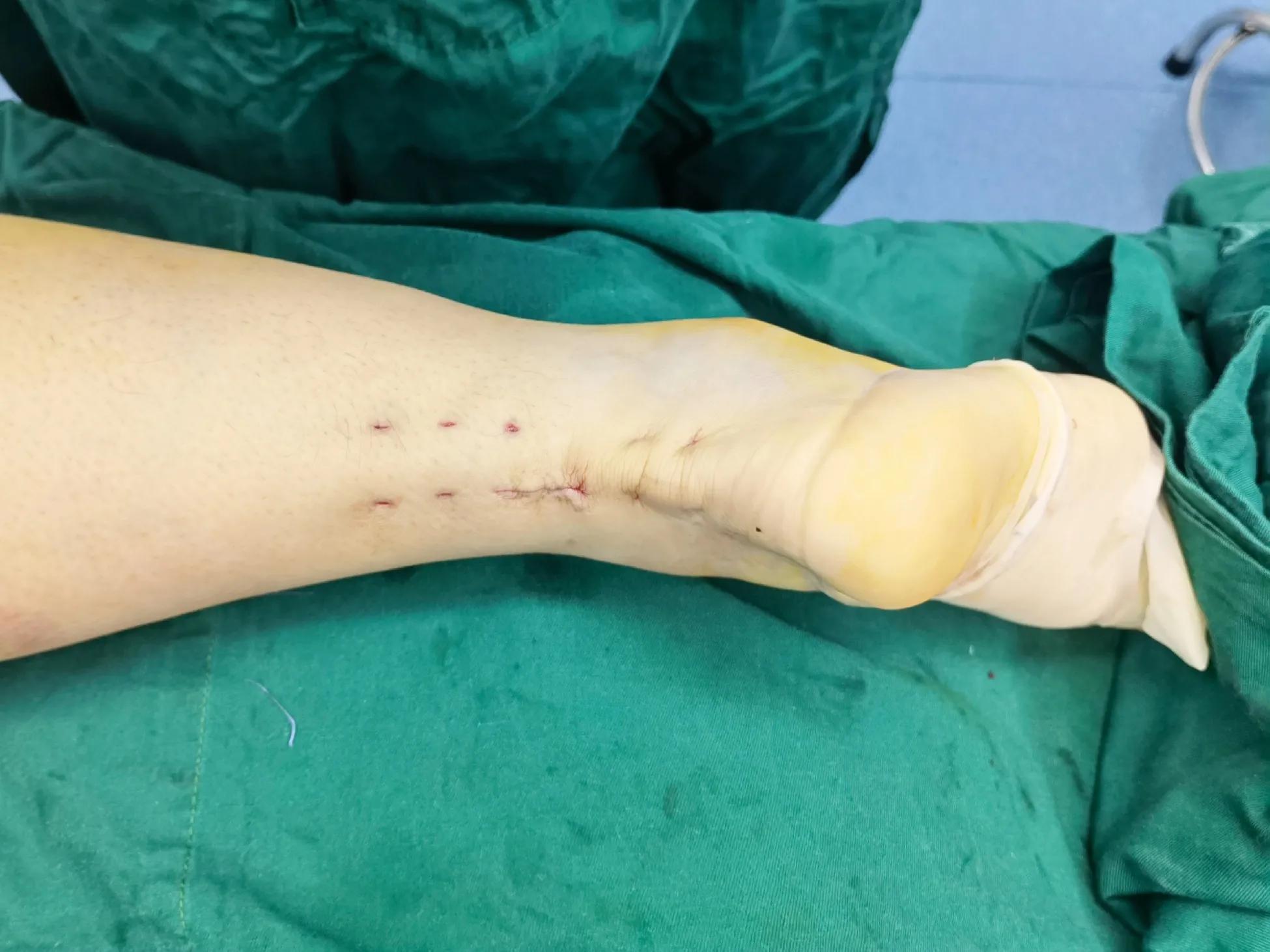 跟腱断裂的微创治疗,跟腱断裂微创手术修复演示图