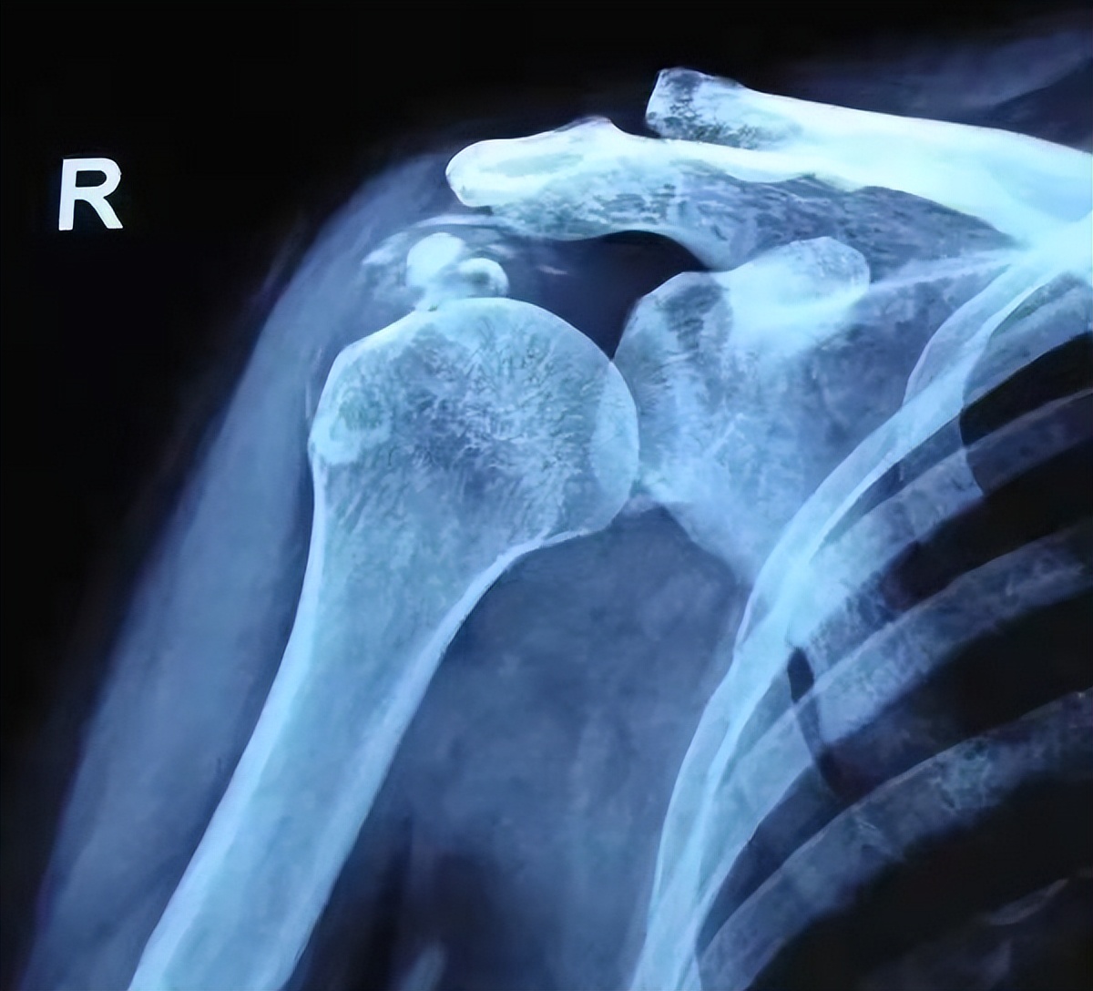 肩部腱膜炎,肩胛冈上肌腱炎的治疗