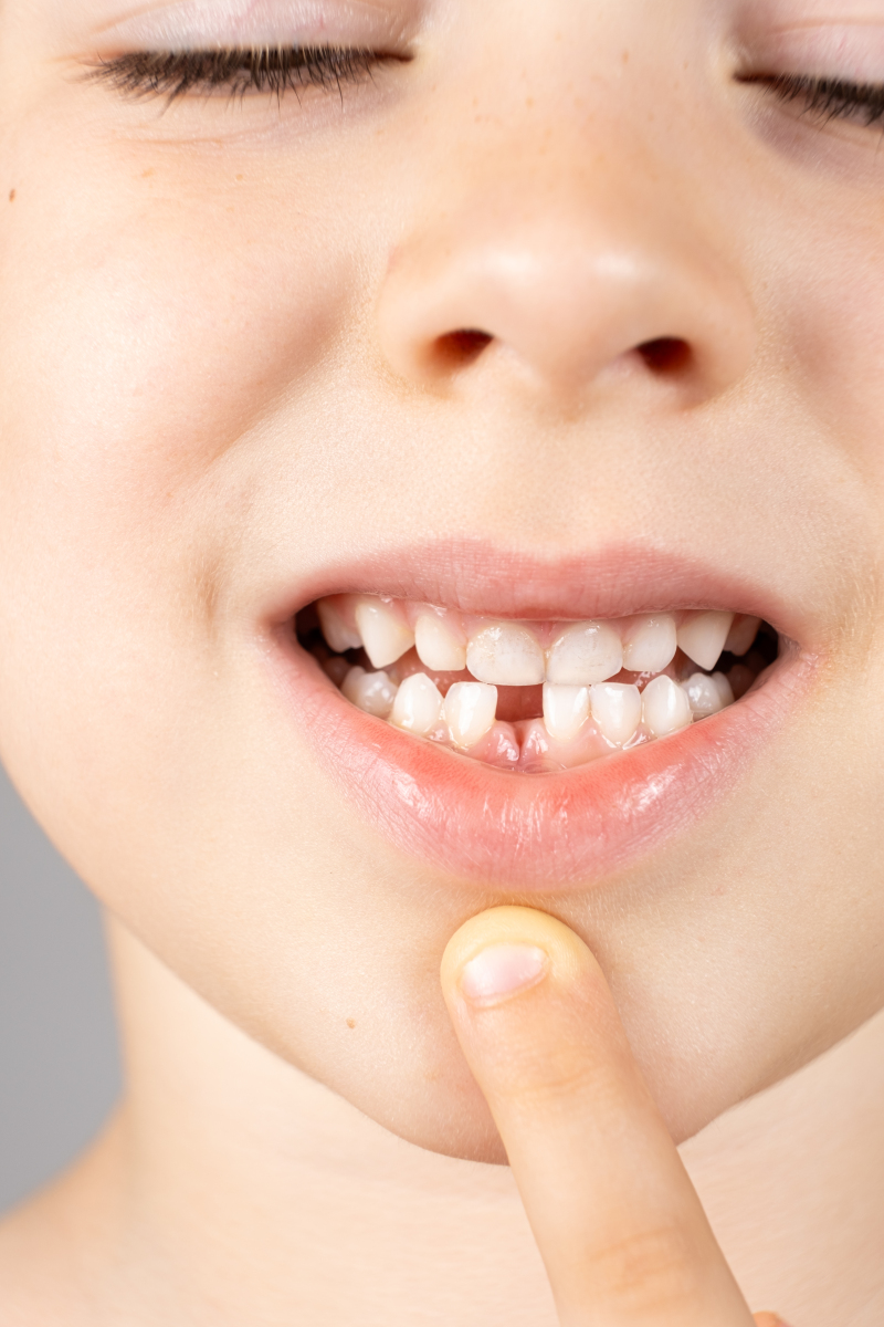 恒牙长出有点斜拔掉乳牙会归位吗,乳牙滞留拔掉后恒牙错位正畸牵引