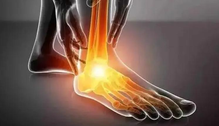 什么是痛风痛风都有哪些表现,什么是痛风痛风的主要症状是什么