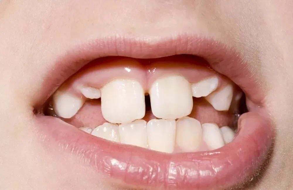 孩子换的新牙畸形牙怎么办,小孩换牙齿出来的好丑怎么办