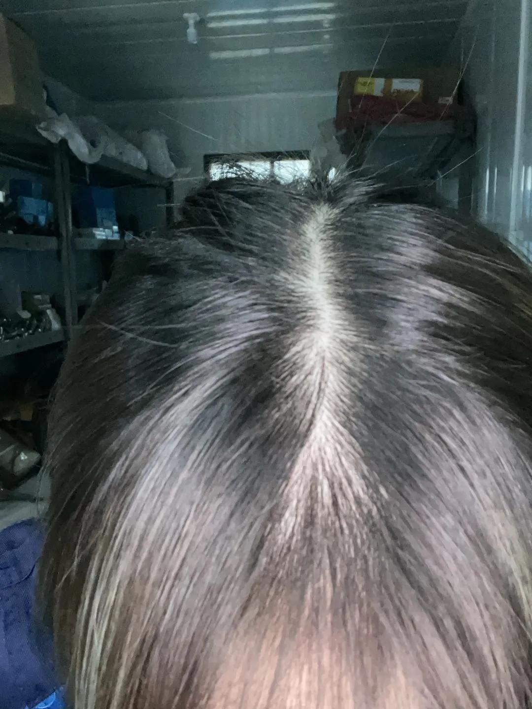 为什么我每天掉头发但还是没秃,总是掉头发快秃了怎么办