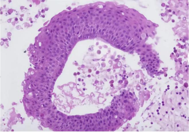 预防术后咽喉痛，最佳方法是什么？