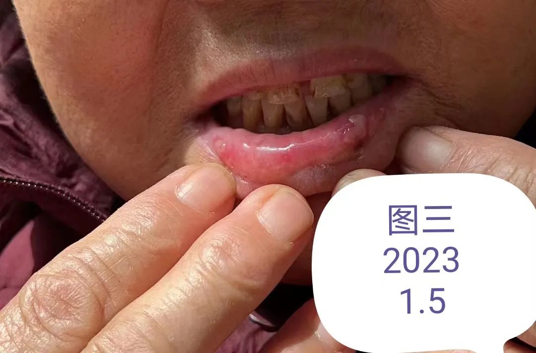 运化失常脾胃湿盛吃什么药,脾胃湿浊最好的治疗方法