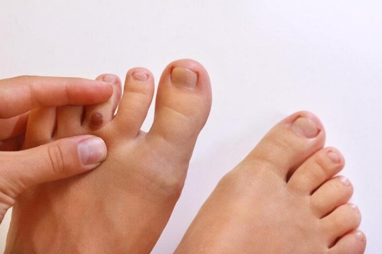 这8个部位长痣或是癌症前兆,痣长在身体这8个部位要小心癌症