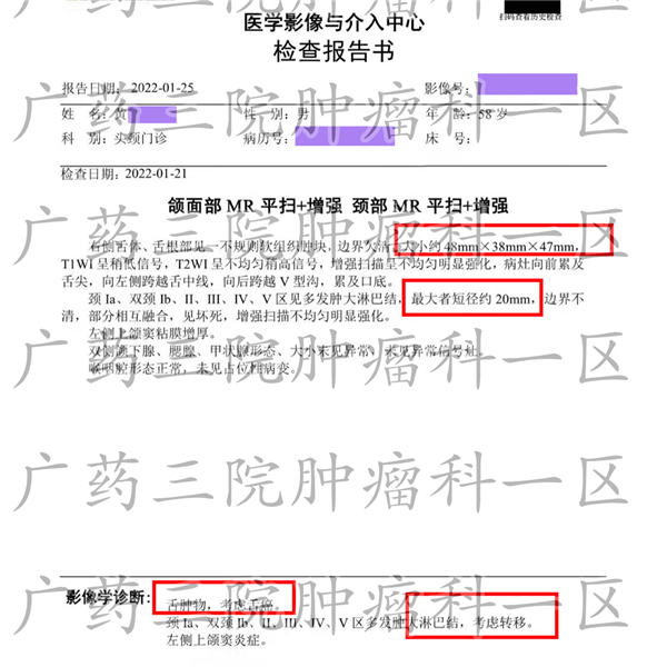 肿瘤科一区介绍中晚期舌癌可以做手术吗