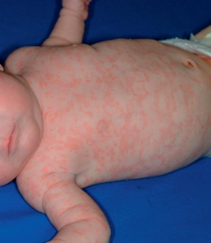 新生儿狼疮综合征,新生儿狼疮怎样引起的