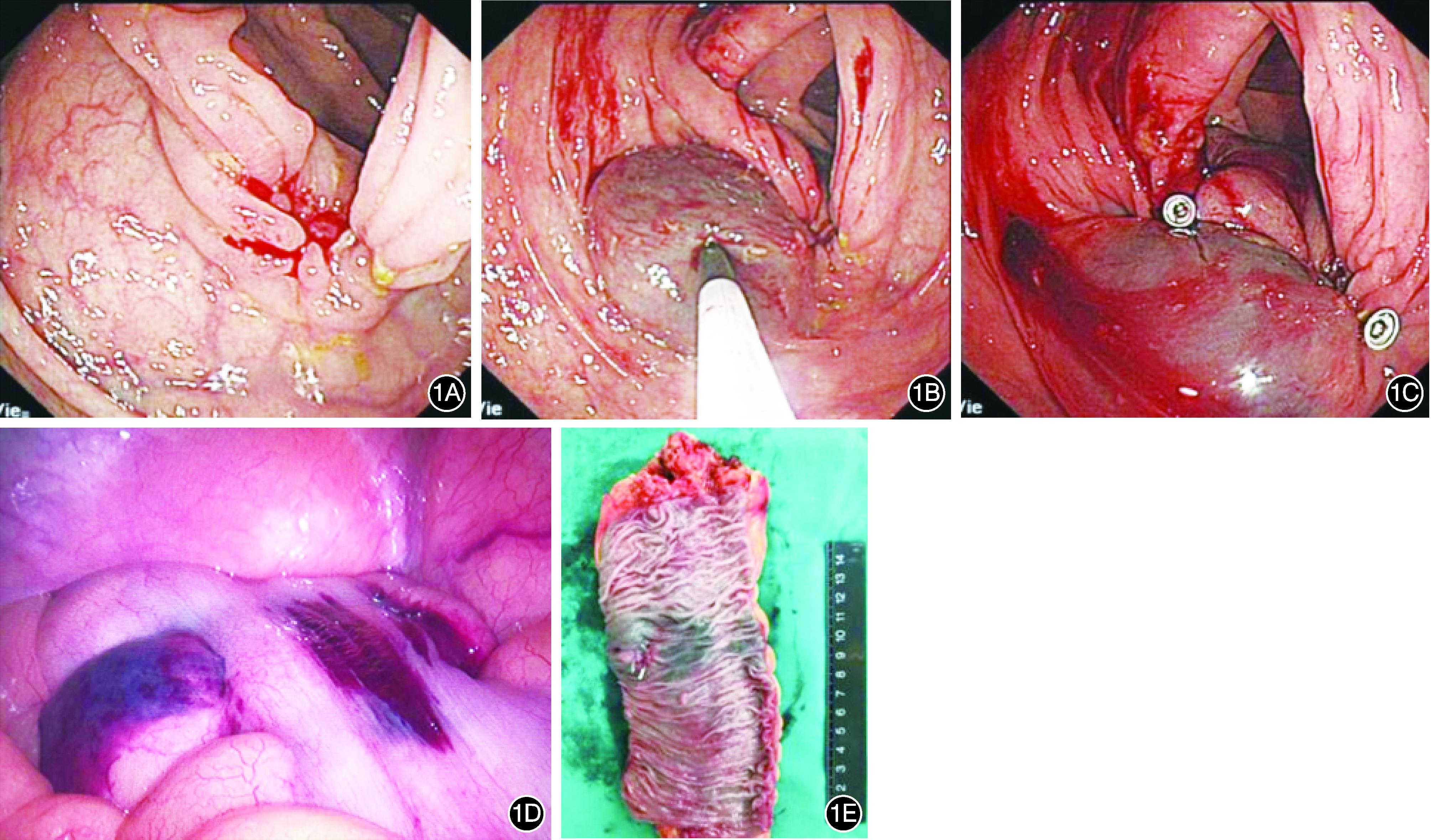 腹腔镜肿瘤术前定位指南,内镜下结肠肿瘤定位