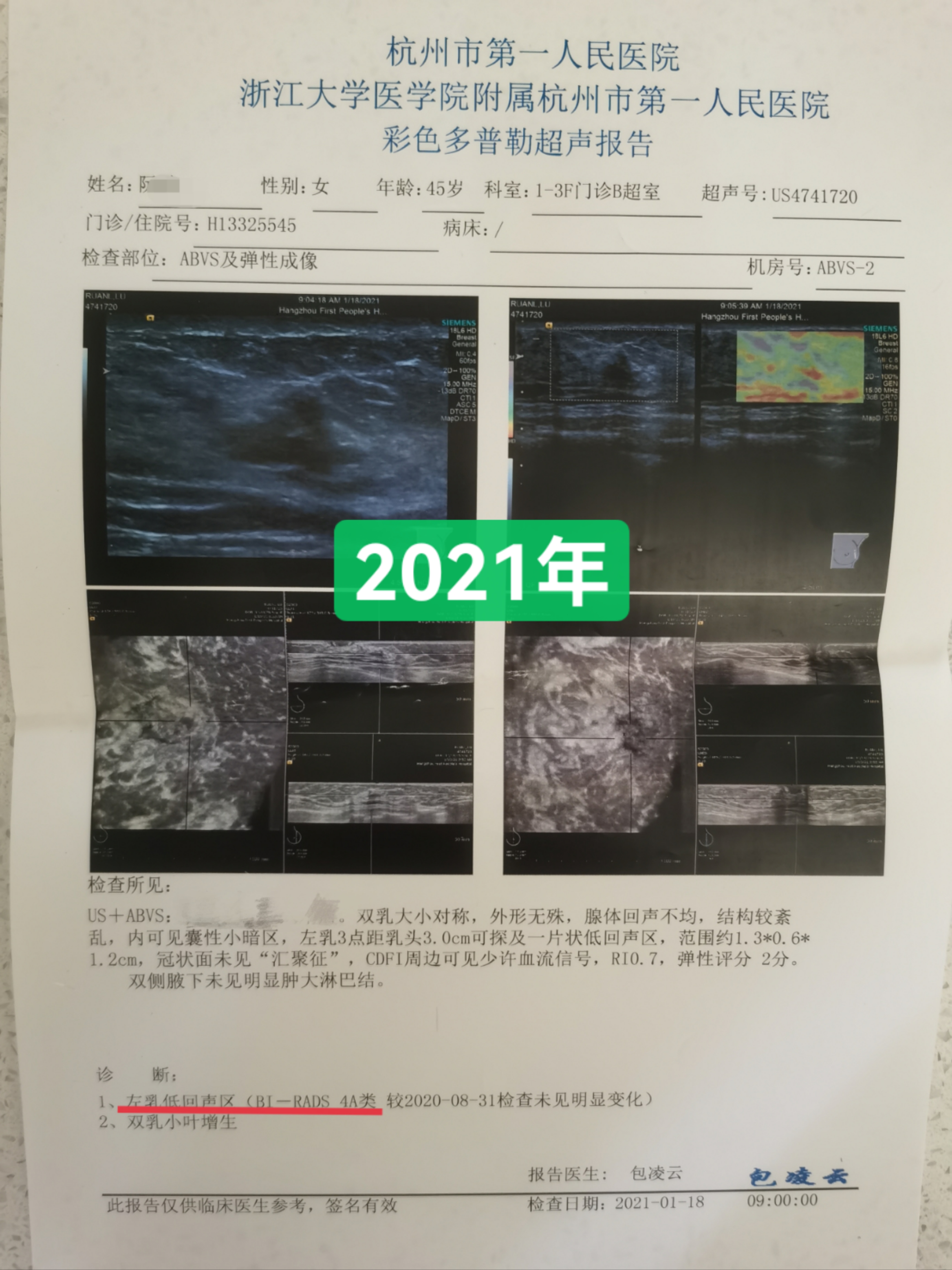 46岁患者乳腺结节3类，服用三个月中药后结节消失