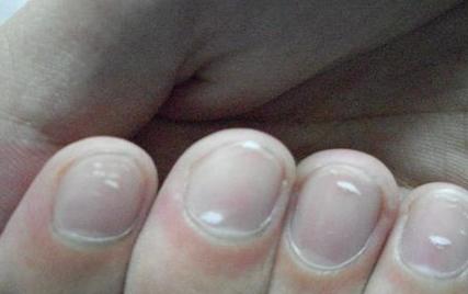 手指甲为什么会出现问题,手指甲和脚指甲有竖纹怎么回事