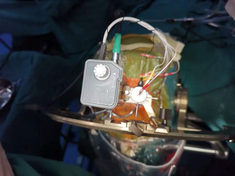 解读脑起搏器治疗帕金森病之三,帕金森脑起搏器体外效果图