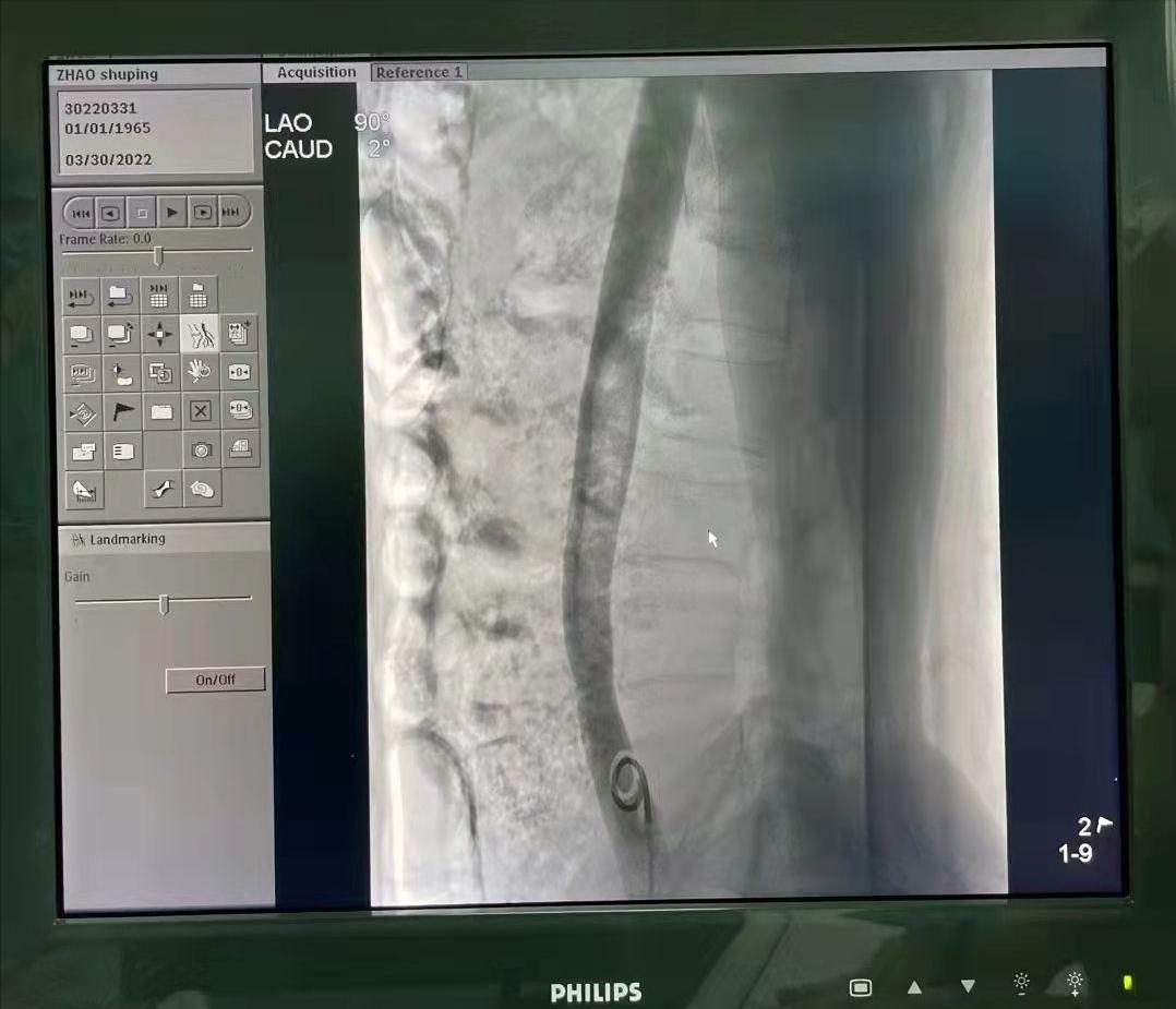 石膏拆了还未消肿怎么回事,长期卧床要注意预防肺栓塞