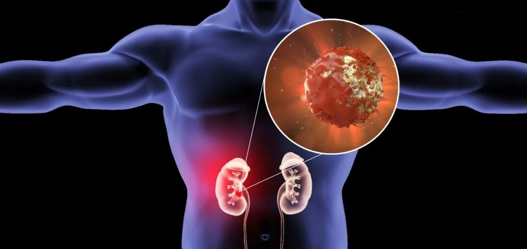 患癌20年经历2次转移最终抗癌成功,肾癌10年后发生转移