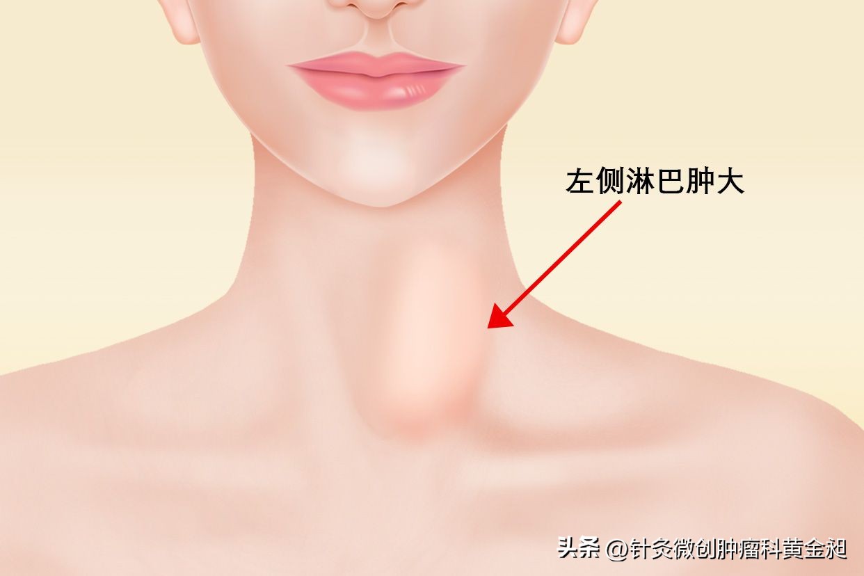 儿童颈部淋巴结怎么消除,放疗能消除颈部淋巴结吗