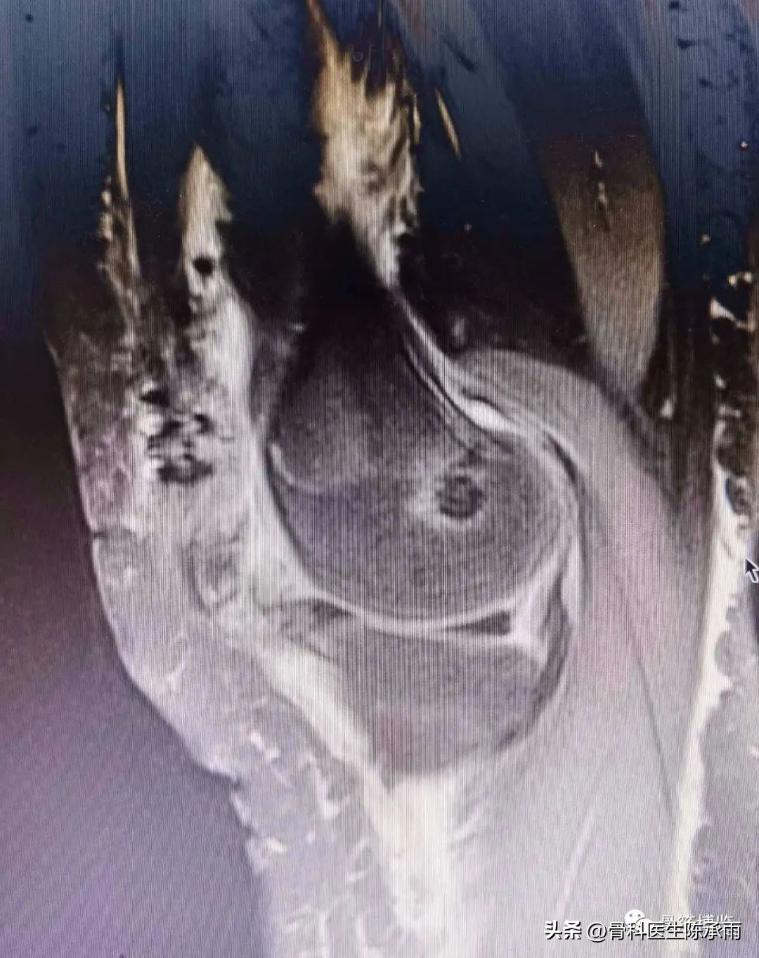 髌骨脱位软骨剥离怎么治疗,半月板撕裂游离体