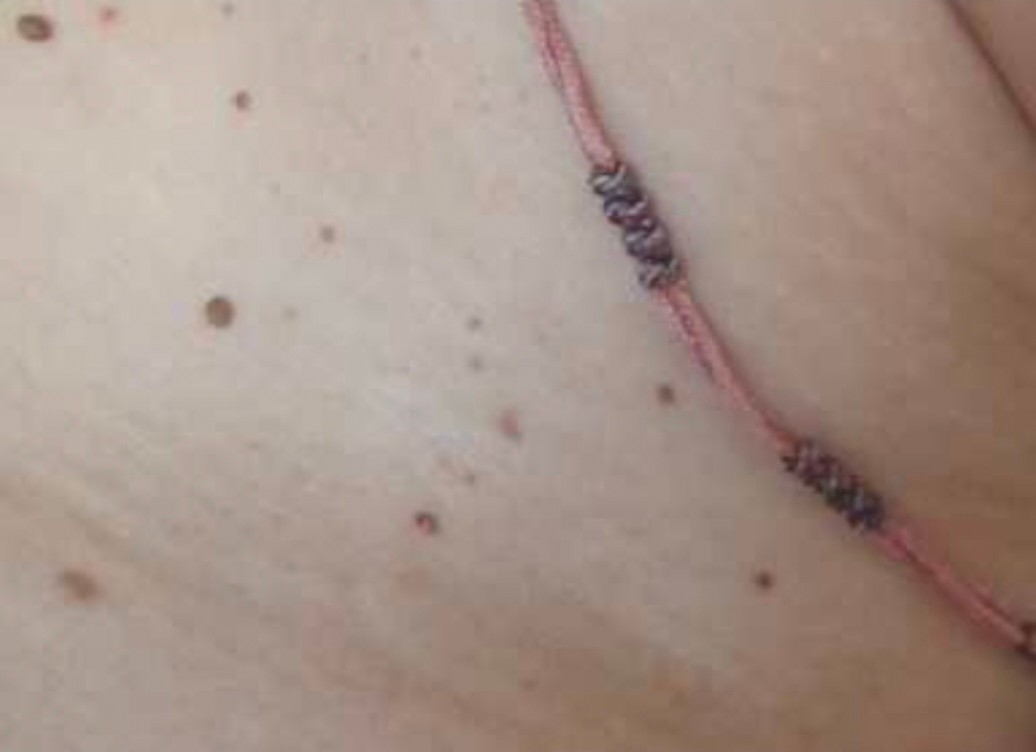 身上长的小肉球抠破会怎么样,身上长的小肉球怎么才能弄掉