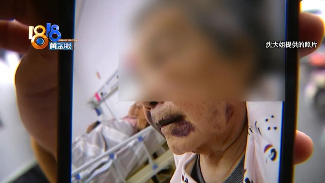 老年人身体有不明淤青,老人脸上出现淤青怎么回事